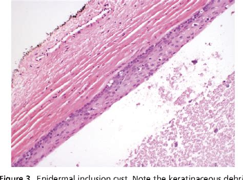 Figure 3 From Vaginal Cysts A Pathology Review Semantic Scholar