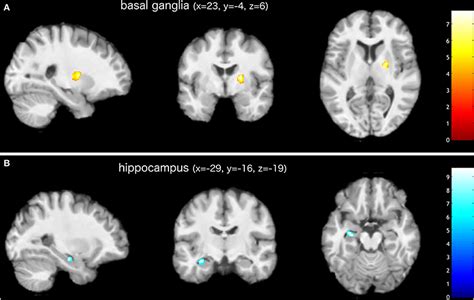 Increased A And Decreased B Gray Matter Volume In Patients After