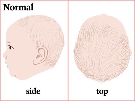 How To Prevent Plagiocephaly Aka Flat Head Syndrome Flat Head