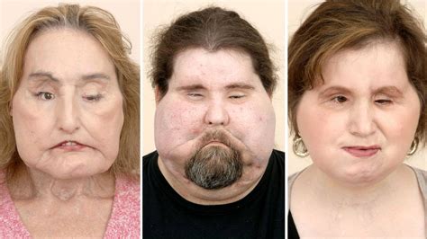 Connie Culp Recipient Of First Near Total Face Transplant In The Us Dies At 57 Boston 25 News