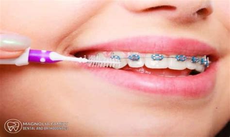 The Top 5 Benefits Of Orthodontic Treatment For A Beautiful Smile