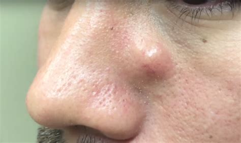 Watch Dr Pimple Popper Extract A Stubborn Growth From This Mans Nose
