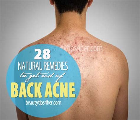 Sweating in tight clothing without immediately showering after is the perfect recipe for back acne. 28 Effective Home Remedies for Back Acne - Natural Beauty ...