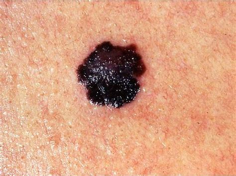 Skin Cancer Or Mole How To Tell Photo 1 Pictures Cbs News