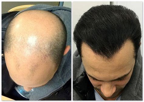 Balding Hair Loss Baldheads Hair Transplant Hair Restoration