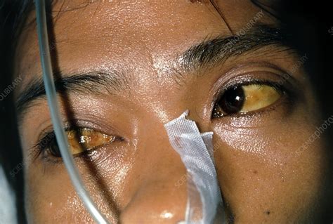 The eyes can turn yellow as a result of jaundice and other conditions. Malaria patient with jaundice, eyes and face. - Stock ...