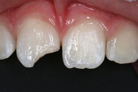 White Fillings Before And After Photos Front Tooth Composite Fillings