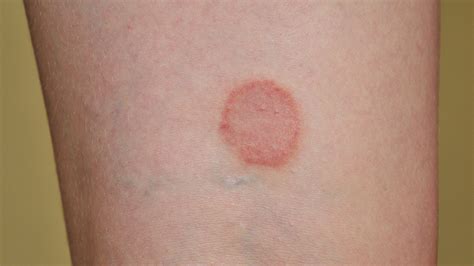 Ringworm In Humans Treatment