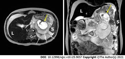 Ruptured Splenic Artery Aneurysms In Pregnancy And Usefulness Of