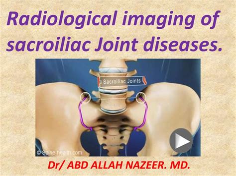 Presentation1pptx Radiological Imaging Of Sacroiliac Joint Diseases