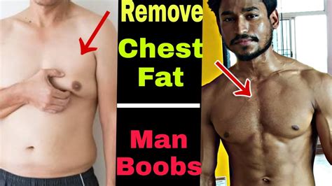 Remove Chest Fat Chest Fat Loss Man Boobs Gynecomastia Chestfat Rohit Xfit Youtube