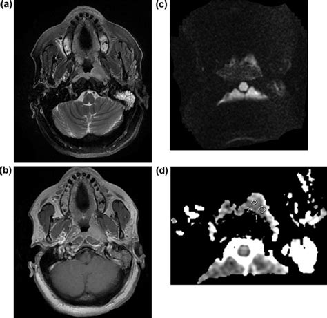 Nasopharyngeal Carcinoma A Axial T2 Weighted Fat Suppression