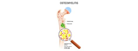 Osteomyelitis Symptoms Causes Diagnosis And Treatment