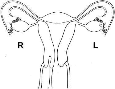 Double Cervix And Vagina With A Normal Uterus And Blind Cervical Pouch
