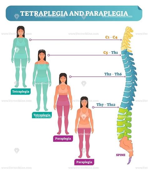 Tetraplegia And Paraplegia Spinal Neural Disorder Vector Illustration