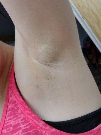 Plugged Milk Duct In Armpit