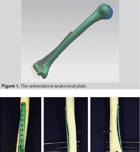 Figure From A NEW ANATOMICAL PLATE FOR EXTRA ARTICULAR DISTAL HUMERAL FRACTURES BIOMECHANICAL