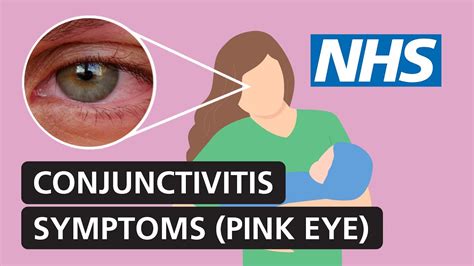 Conjunctivitis Symptoms And Treatment For Red Itchy Watery Eyes Nhs Youtube