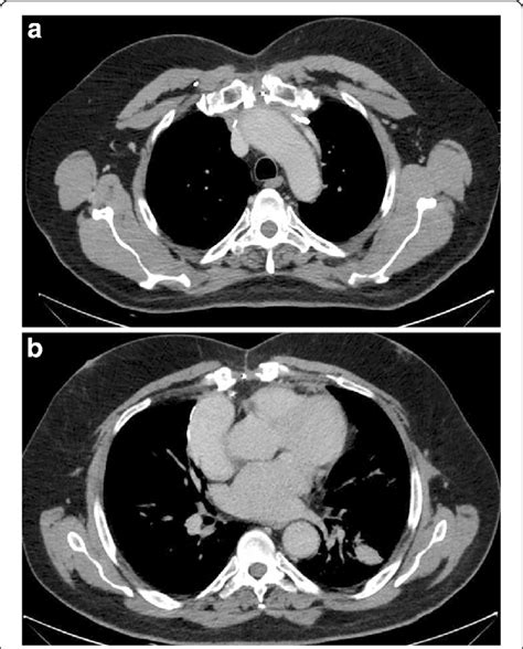 Post Operative Chest Ct Scan Axial View Mediastinal Window At The