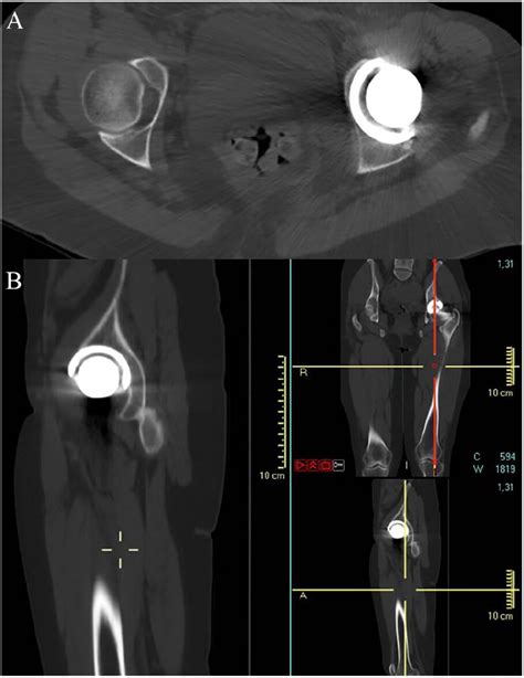 Arthroscopic Tendon Release For Iliopsoas Impingement After Primary