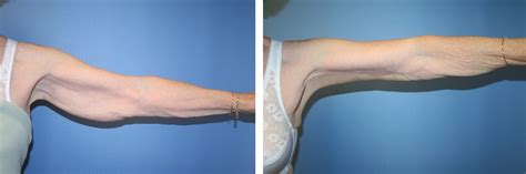 Arm Lift Before And After Pictures Ear Plastic Surgery Healing Time