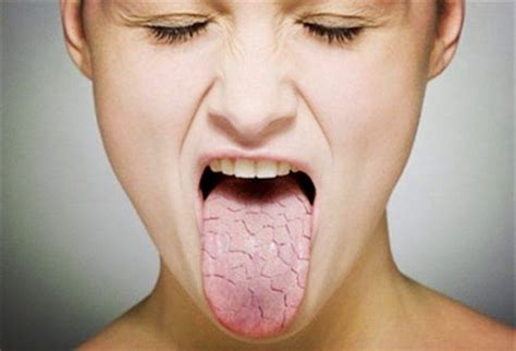 Сухой язык белый обложенный язык с налетом: симптом