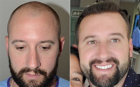 Hair Transplant Miami Hair Restoration Fue Hair Transplant Surgery