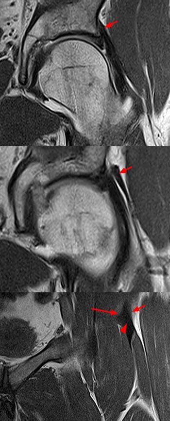 Hip Muscle Anatomy Mri