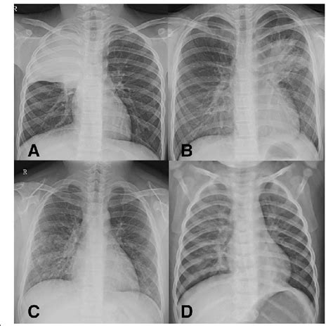 Mycoplasma Pneumonia X Ray Findings