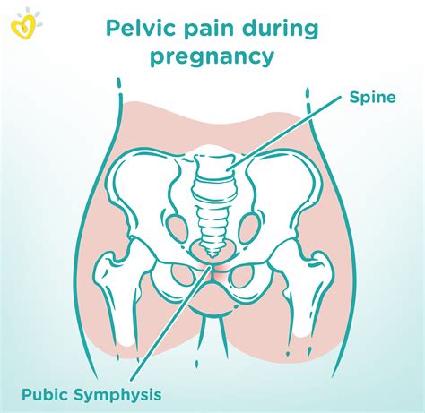 What Is Symphysis Pubis Dysfunction Spd