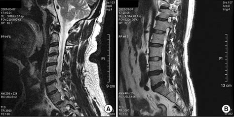 Magnetic Resonance Imaging Findings Of The A Cervical And B Lumbar