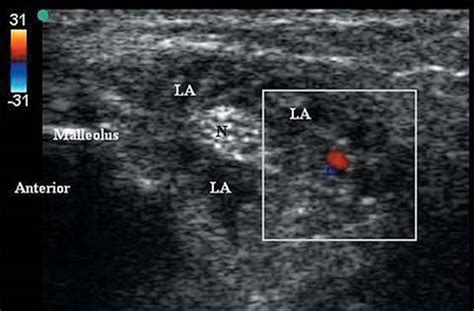 Ultrasound Guided Posterior Tibial Nerve Block Peripheral Nerve