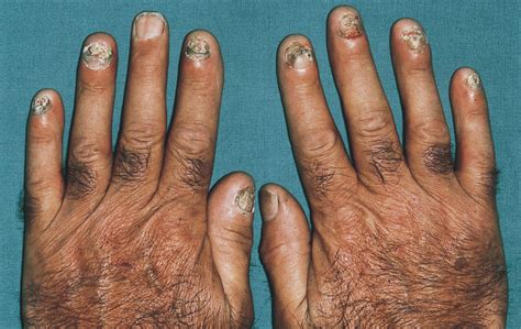 Severe Nail Dystrophy Associated With Painful Fingertips Dermatology