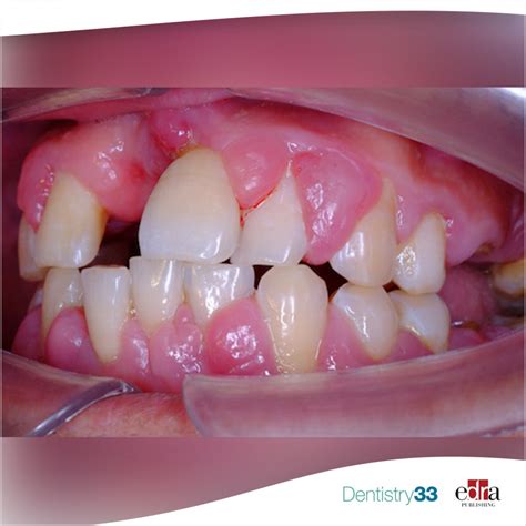 Orthodontic Gingival Hyperplasia