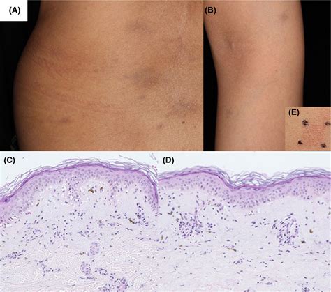 Ashy Dermatosis With A Positive Patch Test To Gold Sodium Thiosulfate