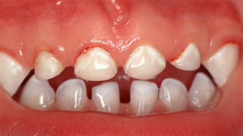 White Spots On Baby Teeth Healthmedline