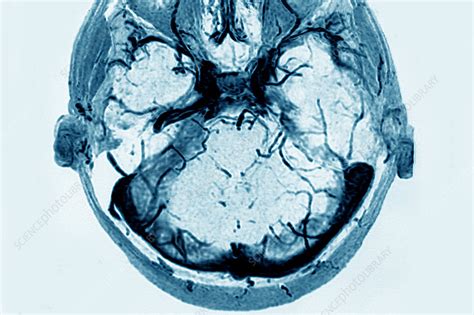 Cerebral Venous Thrombosis Stock Image C0269525 Science Photo