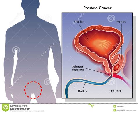 Anatomie, funktion, geschlechtshormone und krankheitszeichen. Prostate Cancer stock vector. Illustration of carcinoma ...