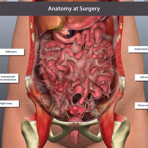 A collection of articles covering abdominal anatomy, including abdominal wall anatomy and abdominal cavity anatomy. Abdominal Anatomy at Surgery - TrialExhibits Inc.