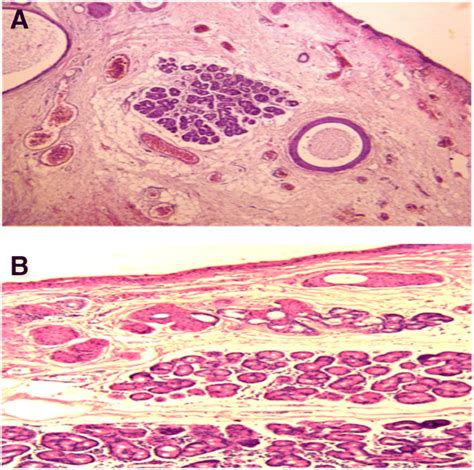 Recurrent Epibulbar Dermoid Cyst Treated With Amniotic Membrane Implant