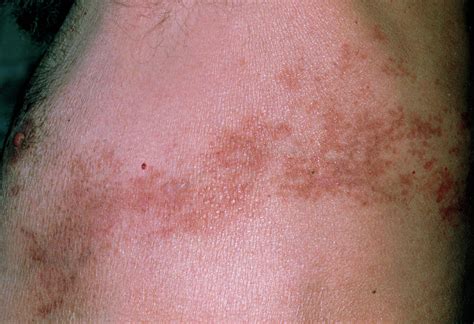 Pigmentation Of Skin Under Arm Due To Shingles Photograph By Dr P
