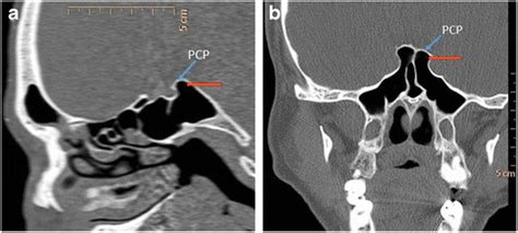 Sagittal And B Coronal Paranasal Computed Tomography Images Demonstrate