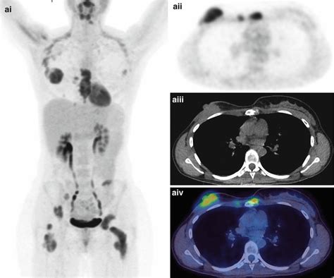 Clinical Applications Of Petct In Oncology Radiology Key