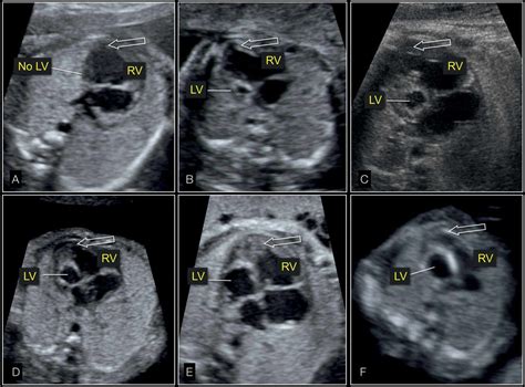 Hypoplastic Left Heart Syndrome Four Chamber View Showing Absent A