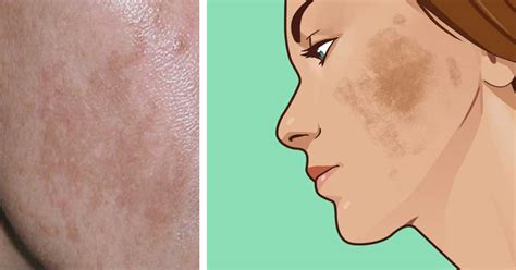 6 Easy Ways To Help Treat Dark Skin Patches At Home Skin