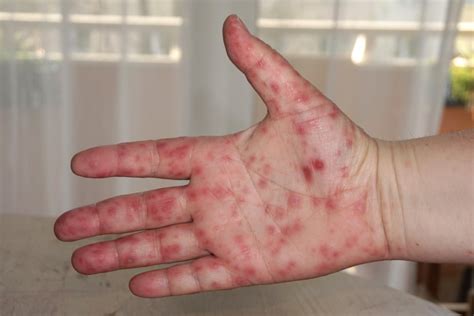 Hand Foot And Mouth Disease Is Highly Contagious — This Is How To