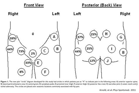 Hip Pain Location Chart Diagram