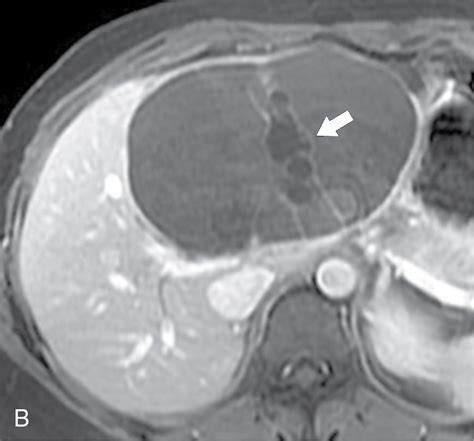 Benign Focal Liver Lesions Radiology Key