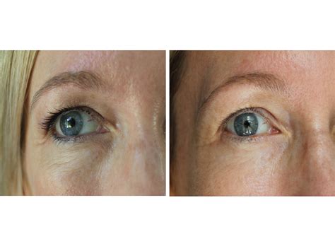 Retin A Under Eyes Before And After Pictures Picturemeta