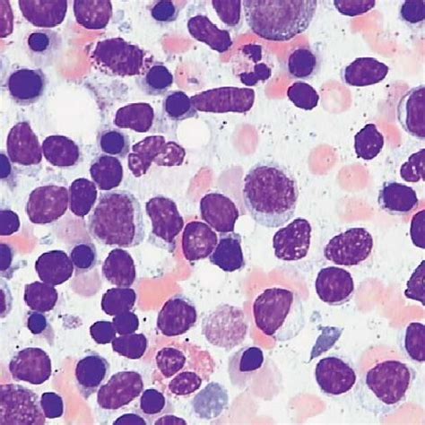 Large Lymphocytic Granular Cells In Bone Marrow May Grünwald Giemsa